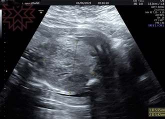 人妻產檢 醫見寶寶「肚子長巨大腫瘤」最後結局曝