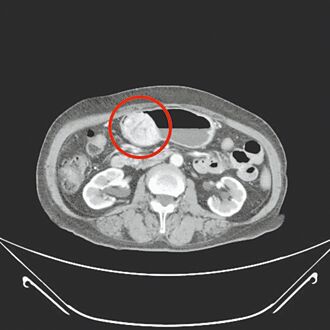 胃腸道基質瘤合併膽結石 微創手術根除