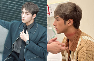 27歲男神驚爆重傷！頸動脈見「超深血痕」畫面曝：腦中一片空白