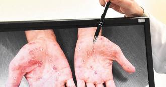 小三生染梅毒！青少女梅毒病例10年暴增53倍