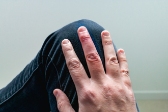 手指出現1變化他嚇壞 急奔醫院檢查 竟確診肺癌