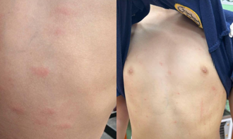 嘉義竹崎親水公園熱門戲水池傳過敏 孩童戲水後全身起紅疹