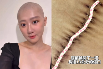 32岁女星消失半年「惊传罹癌」！ 化疗6次长髮剃光妈泪崩