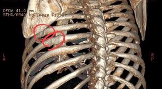 40岁男猛咳「胸腔啪一声」 医傻眼：这是第5次肋骨断了
