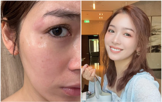 大馬女星臉部被「台灣髮廊」高溫燙傷！ 怒控業者冷處理