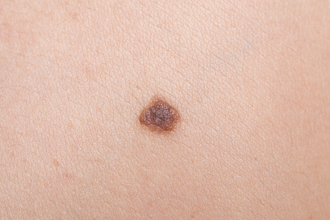 50歲以上小心！鼻長痣不是招財 醫：癌症上身