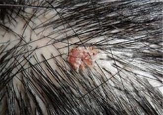 天熱頭皮毛囊炎爆發！ 醫示警藥膏別亂擦揭治療關鍵