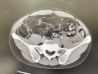 男子腹脹 小腸驚見近百顆腫瘤