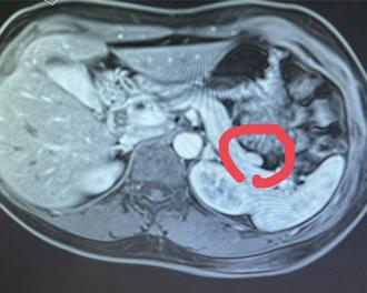 早上爬不起來、空腹就亂講話…40歲婦罹這罕病：以為卡到陰