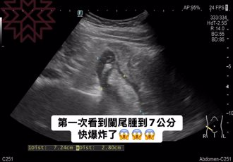 她胃超痛以為腸胃炎 醫一照驚：闌尾腫成7公分 快爆炸