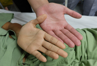 手掌變鴨掌不一定肝出問題 醫揭4情況也會：已中毒