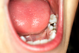 蛀牙竟害心臟被吃掉！細菌到處跑 6歲童半身遭破壞