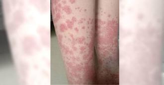 杭州女大生染髮成癮險丟命！全身爆紫斑「剃光頭保命」