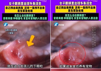 養貓女眼皮發癢發紅 竟是眼皮下有「這生物」