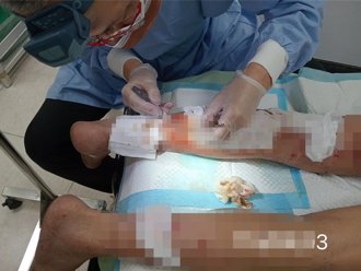 鹽酸灼傷驚險救治！23天恢復新生皮膚 醫護合作創奇蹟