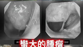 30岁男鼻塞3个月竟是癌 医一看：肿瘤填满鼻腔