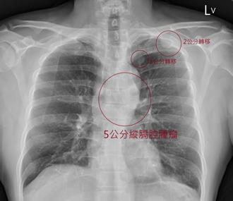 没有不舒服！40岁男不菸不酒 X光一照「已癌末到处转移」