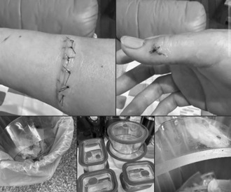 全聯換購玻璃保鮮盒從冰箱拿出突「自爆」 割斷女手腕肌腱 官方回應了