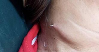 泰女喝汤误吞鱼刺 卡喉咙2周「从脖子插出」画面惊悚