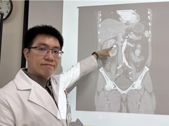 夏天喝水少小心！61歲男腎結石復發「險出人命」