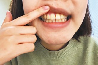 洗牙不是美白 物理性去污卡有效