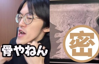 網紅「世界最長下巴」X光照出爐！醫師也看呆：獨一無二