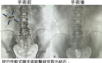 夏天爆增！急診擠滿「這類」患者 醫揭尿路結石警訊