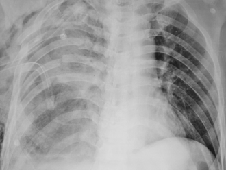 肺部結節出現1情況 癌變風險增13.77倍 尤其是女性