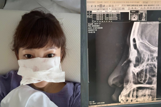張涵雅鼻骨遭兒子撞斷！「超慘近照」曝光 網驚：看起來好痛