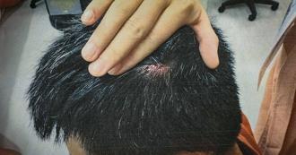 街頭藝人慘遭恐怖男友玻璃瓶砸頭　分手逼淨身出戶剩40元