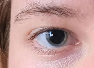 女分享瞳孔照「怪怪的」 一群醫師留言：妳差點就死了