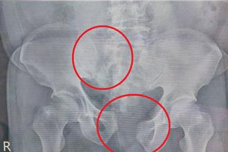 7旬翁墜3樓骨盆碎！醫院「神救援」 險休克到康復只花1周