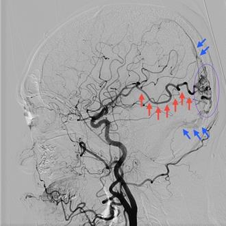 腦中不定時炸彈！45歲女突昏迷 竟是「顱內動靜脈畸形」惹禍