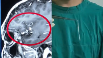 37岁男突失语！脑袋藏10公分寄生虫 开颅取出还在动