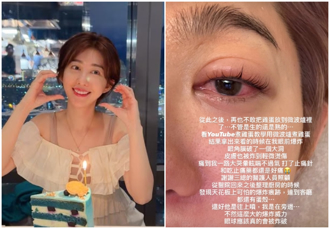 女星微波鸡蛋爆炸！眼角膜破裂「流理台也炸碎」近况曝：快昏去
