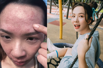 滴妹出國騎馬「過敏臉爛」！滿臉紅腫氣喘發作 險些送急診