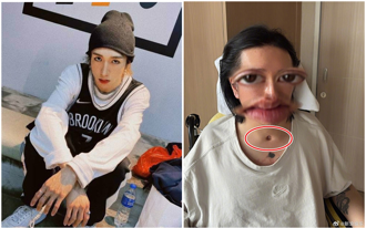 「大螢幕砸頭」舞者癱瘓3年首度曝近照！鎖骨驚見插管大洞惹心疼