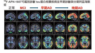 生技業 拚破解失智症挑戰