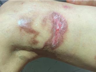 出國前夕遭3級燒燙傷 醫用AI傷口分析助患者海外遠距照護