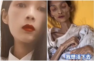 27歲正妹胃萎縮「爆瘦至17公斤」像骷髏！ PO片求援悲慘身世曝