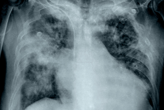 肺有毛玻璃就是癌？她收报告吓哭 医曝3关键喊先别慌