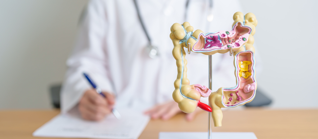 醫師表示，台灣人好發大腸癌，恐與不當飲食與生活習慣有關。（示意圖，Shutterstock／達志）