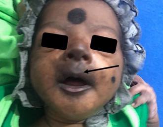 大陆屈公病爆发 幼童染病「脸变包青天」 医急示警