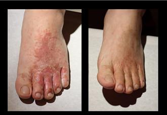 豪雨後皮膚病患增！台中1類鼻疽確診 醫曝香港腳增2成