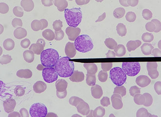 抽菸也會傷骨髓 每天20支抽10年 血癌風險飆2倍 
