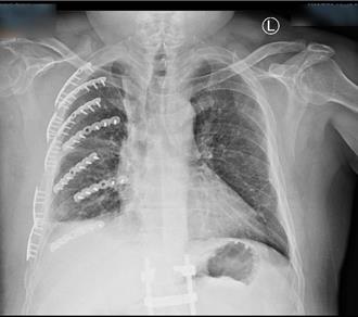 5旬男遭遊覽車撞斷14根肋骨 2科室醫師聯手重建胸廓助重生