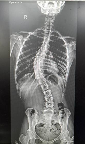 女脊椎側彎53度！ 微創手術助挺直還增高6公分