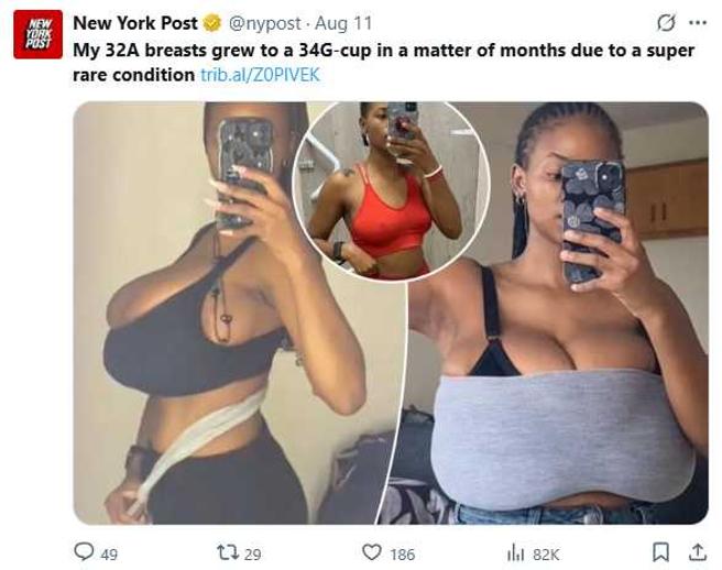 南非女子米雪兒因巨乳症胸圍暴增至34G，生活與心理都受到影響（圖／翻攝自X，@nypost）