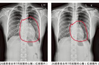 沒喘沒胸悶！妙齡女X光揭心臟衰竭 竟是甲狀腺亢進惹禍