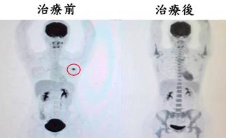 37歲女罹三陰性乳癌 「先期化療再開刀」腫瘤細胞全消失